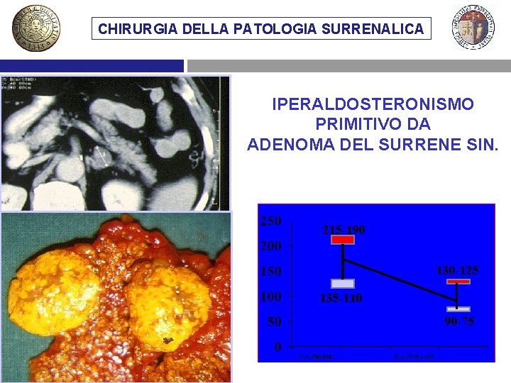 CHIRURGIA DELLA PATOLOGIA SURRENALICA IPERALDOSTERONISMO PRIMITIVO DA ADENOMA DEL SURRENE SIN. 215 -190 130