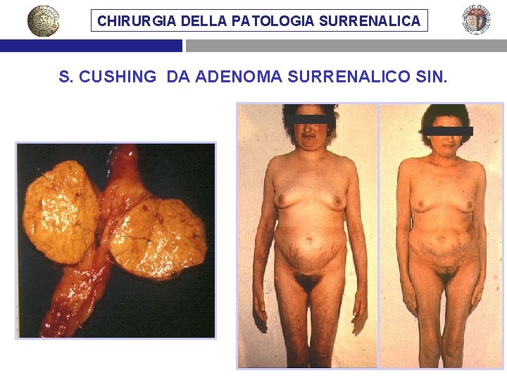 CHIRURGIA DELLA PATOLOGIA SURRENALICA S. CUSHING DA ADENOMA SURRENALICO SIN. 