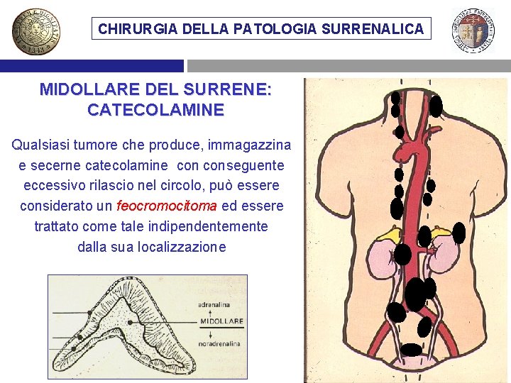 CHIRURGIA DELLA PATOLOGIA SURRENALICA MIDOLLARE DEL SURRENE: CATECOLAMINE Qualsiasi tumore che produce, immagazzina e