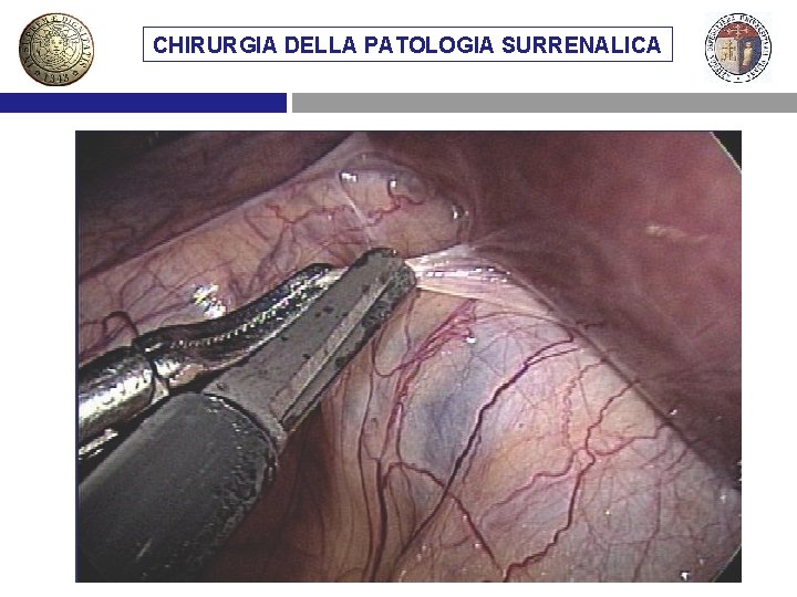 CHIRURGIA DELLA PATOLOGIA SURRENALICA VIE DIMETASTASI ACCESSO CHIRURGICO AL SURRENE SURRENALICHE 