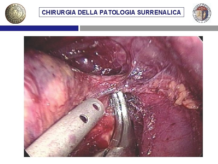 CHIRURGIA DELLA PATOLOGIA SURRENALICA VIE DIMETASTASI ACCESSO CHIRURGICO AL SURRENE SURRENALICHE 