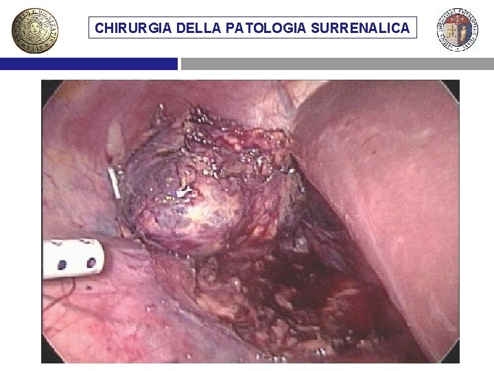 CHIRURGIA DELLA PATOLOGIA SURRENALICA VIE DIMETASTASI ACCESSO CHIRURGICO AL SURRENE SURRENALICHE 