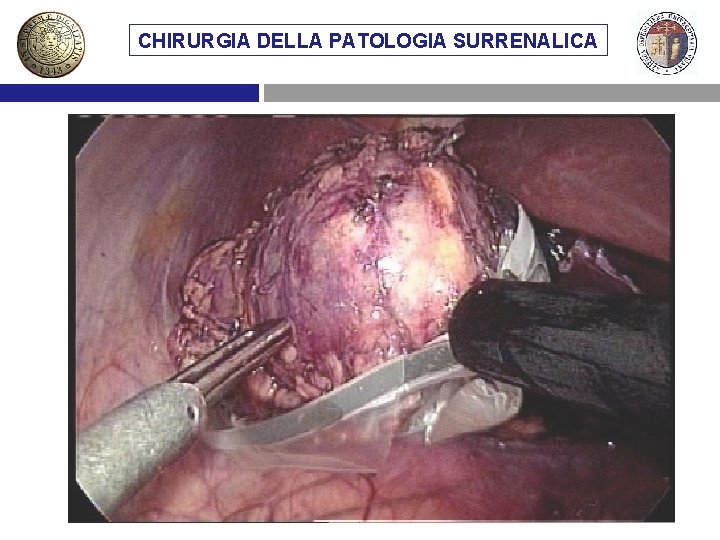 CHIRURGIA DELLA PATOLOGIA SURRENALICA VIE DIMETASTASI ACCESSO CHIRURGICO AL SURRENE SURRENALICHE 