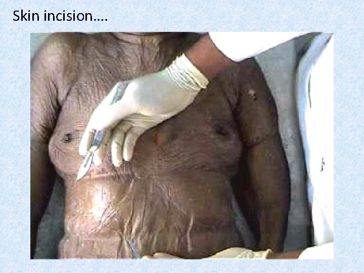 Skin incision…. 