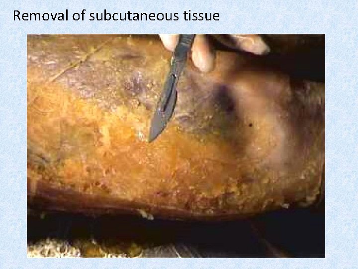 Removal of subcutaneous tissue 