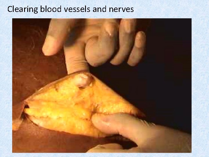 Clearing blood vessels and nerves 