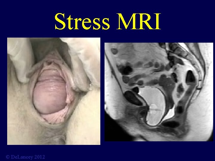 Stress MRI © De. Lancey 2012 