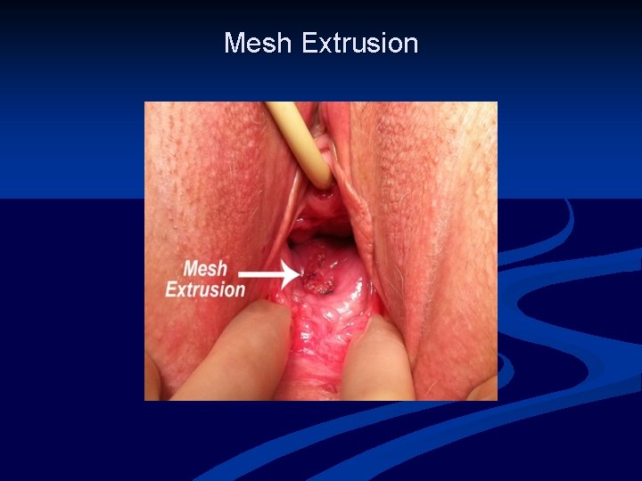 Mesh Extrusion 