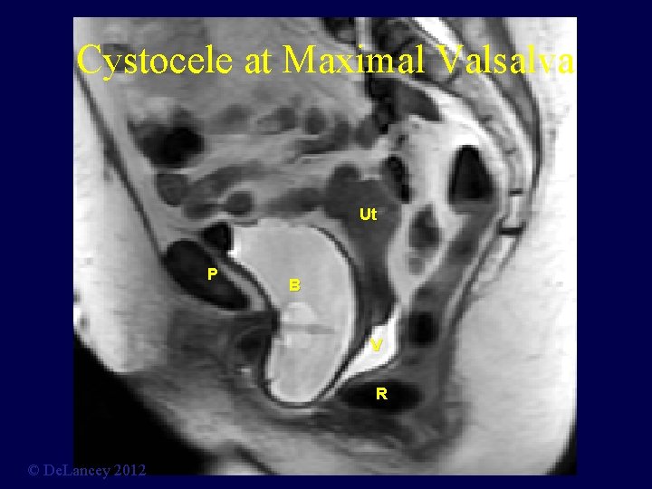 Cystocele at Maximal Valsalva Ut P B V R © De. Lancey 2012 