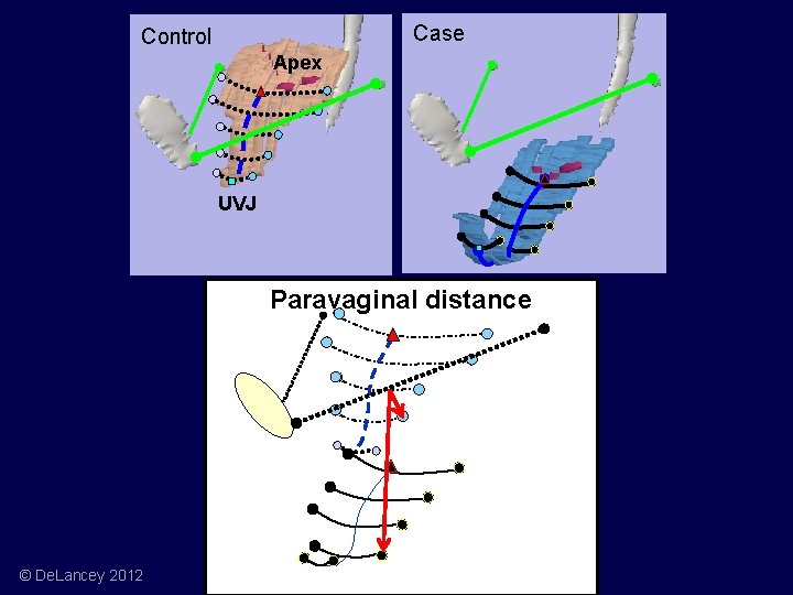 Case Control Apex UVJ Paravaginal distance © De. Lancey 2012 