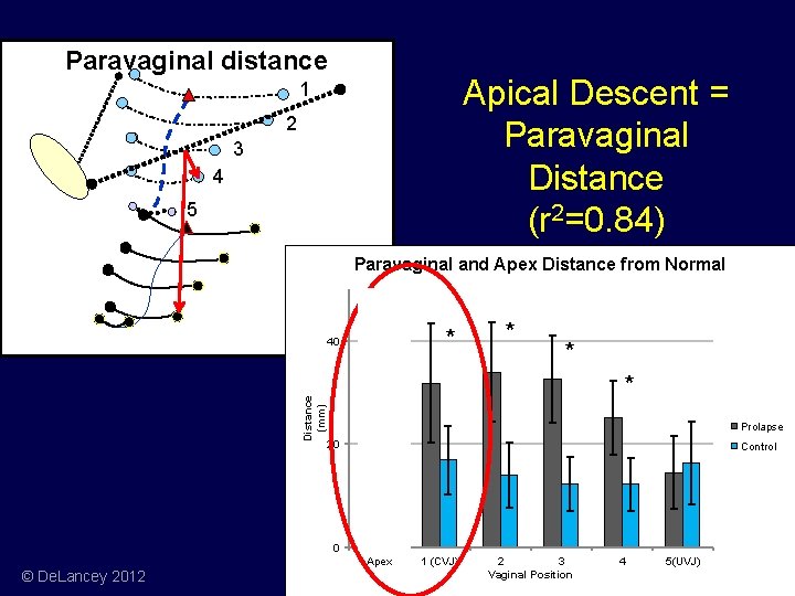 Paravaginal distance Apical Descent = Paravaginal Distance (r 2=0. 84) 1 2 3 4