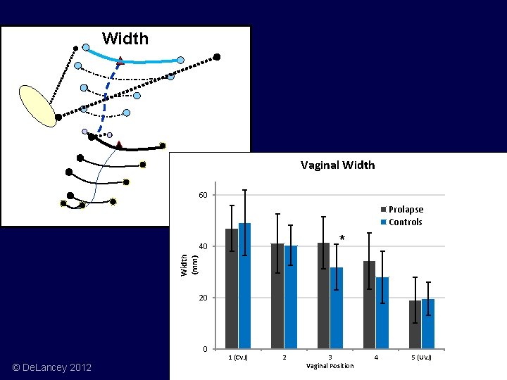 Width Vaginal Width 60 Prolapse Controls * Width (mm) 40 20 0 © De.