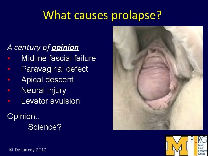 What causes prolapse? A century of opinion • • • Midline fascial failure Paravaginal