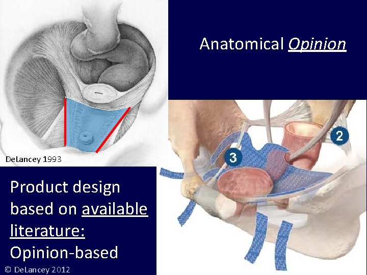 Anatomical Opinion De. Lancey 1993 Product design based on available literature: Opinion-based © De.