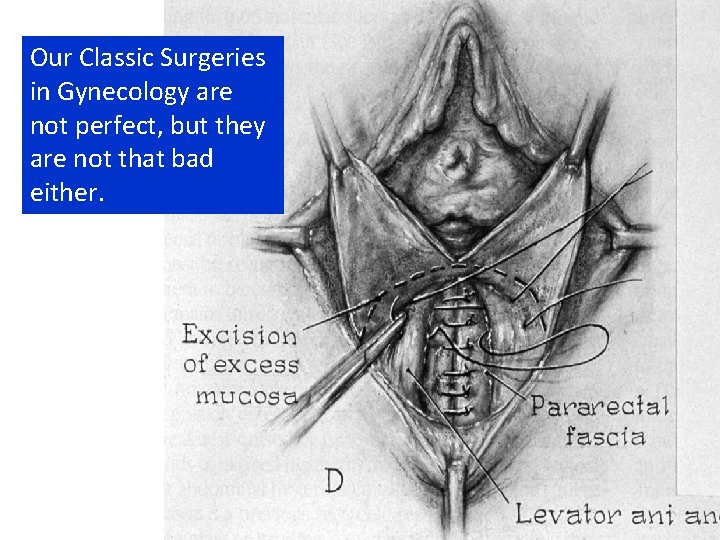 Our Classic Surgeries in Gynecology are not perfect, but they are not that bad