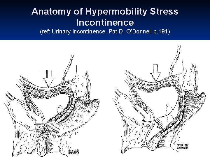 Anatomy of Hypermobility Stress Incontinence (ref: Urinary Incontinence. Pat D. O’Donnell p. 191) 