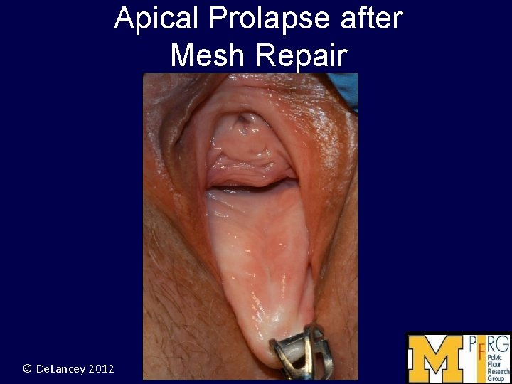 Apical Prolapse after Mesh Repair © De. Lancey 2012 