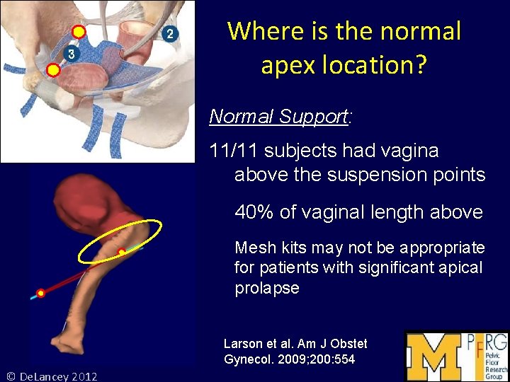 Where is the normal apex location? Normal Support: 11/11 subjects had vagina above the