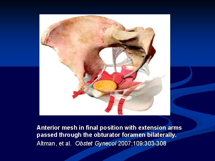 Anterior mesh in final position with extension arms passed through the obturator foramen bilaterally.