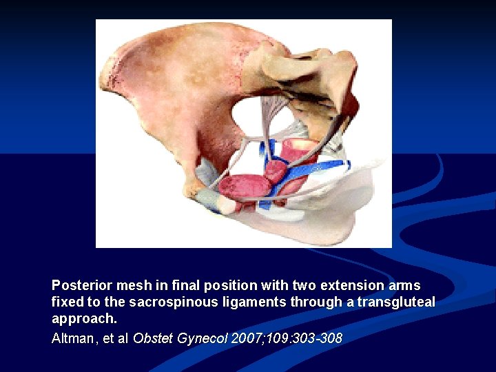 Posterior mesh in final position with two extension arms fixed to the sacrospinous ligaments
