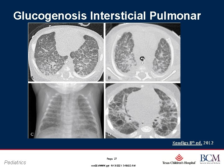 Glucogenosis Intersticial Pulmonar Kendigs 8 th ed. 2012 Pediatrics Page 27 xxx 00. #####.