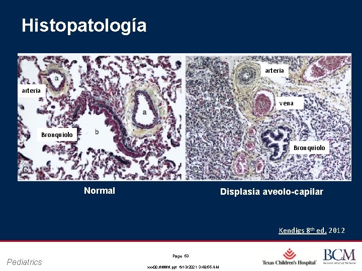 Histopatología arteria vena Bronquiolo Normal Displasia aveolo-capilar Kendigs 8 th ed. 2012 Pediatrics Page