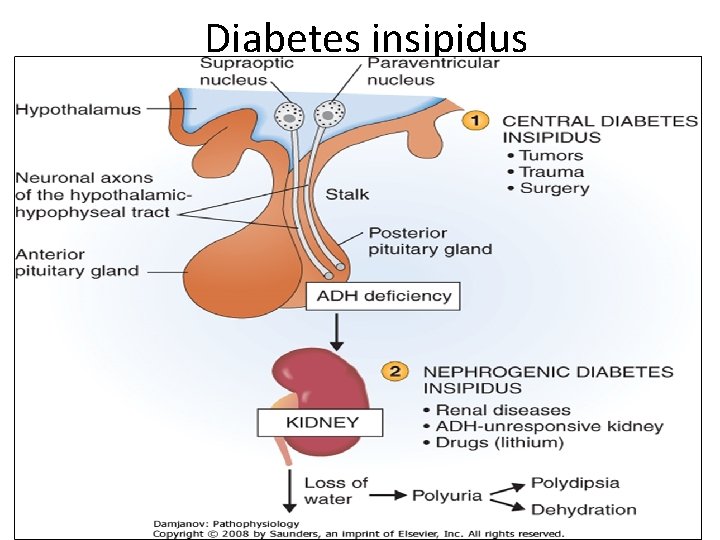 Diabetes insipidus 