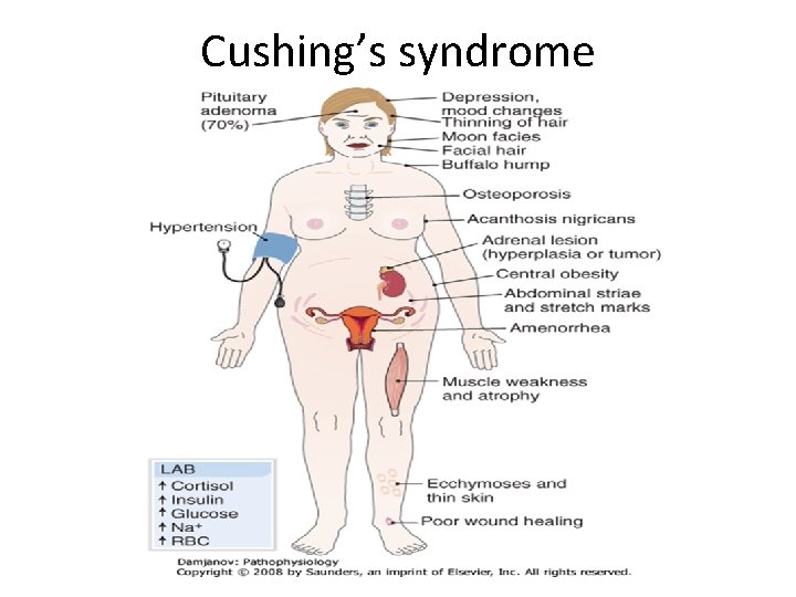 Cushing’s syndrome 
