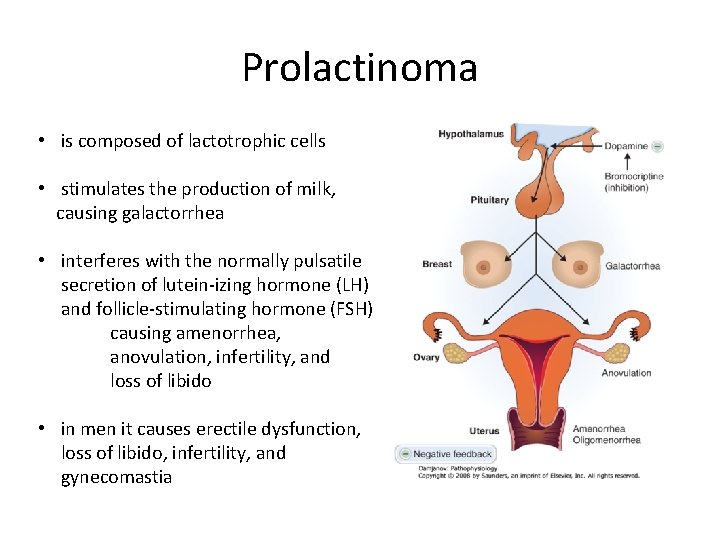Prolactinoma • is composed of lactotrophic cells • stimulates the production of milk, causing
