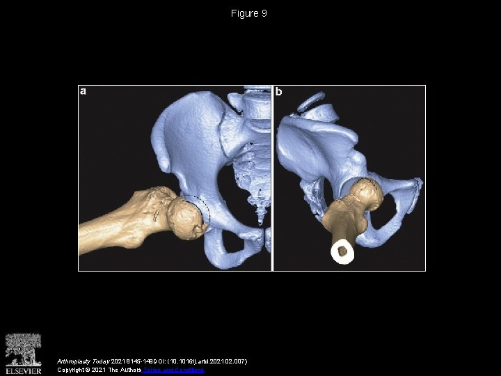 Figure 9 Arthroplasty Today 2021 8145 -149 DOI: (10. 1016/j. artd. 2021. 02. 007)