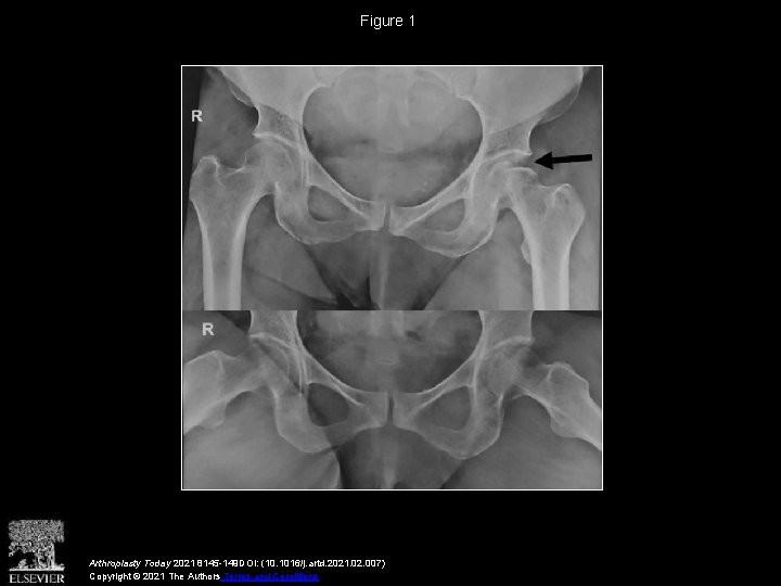 Figure 1 Arthroplasty Today 2021 8145 -149 DOI: (10. 1016/j. artd. 2021. 02. 007)