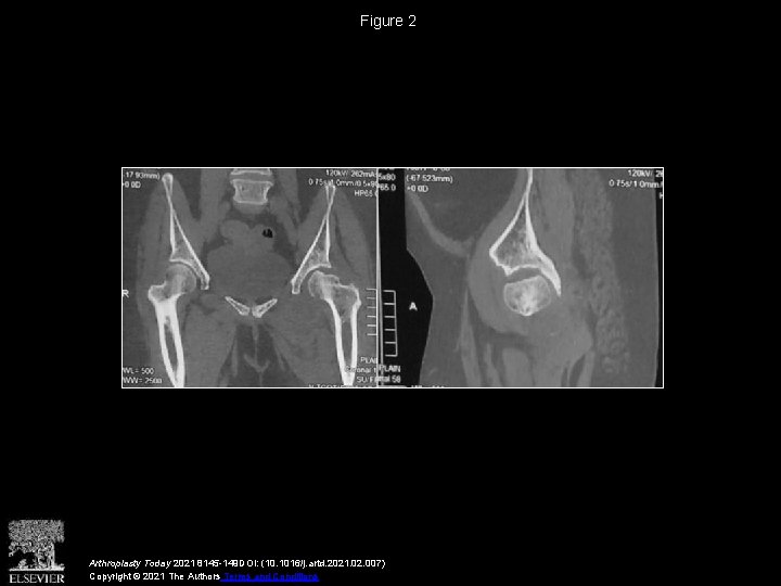 Figure 2 Arthroplasty Today 2021 8145 -149 DOI: (10. 1016/j. artd. 2021. 02. 007)