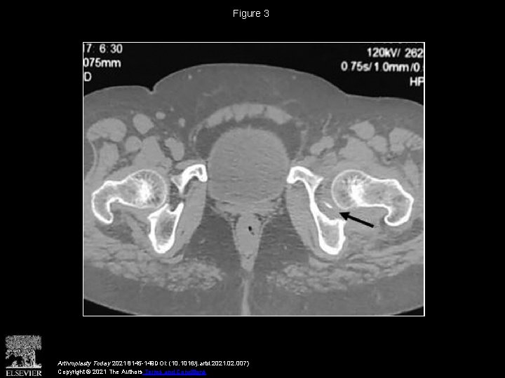 Figure 3 Arthroplasty Today 2021 8145 -149 DOI: (10. 1016/j. artd. 2021. 02. 007)