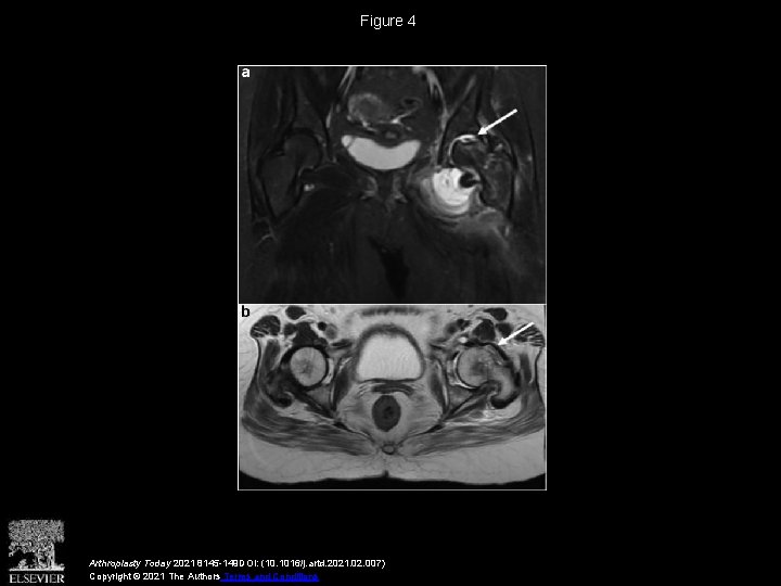 Figure 4 Arthroplasty Today 2021 8145 -149 DOI: (10. 1016/j. artd. 2021. 02. 007)