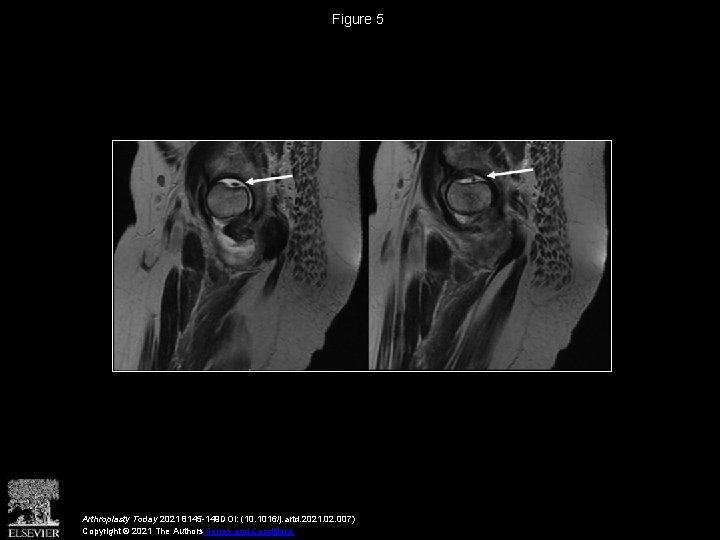 Figure 5 Arthroplasty Today 2021 8145 -149 DOI: (10. 1016/j. artd. 2021. 02. 007)