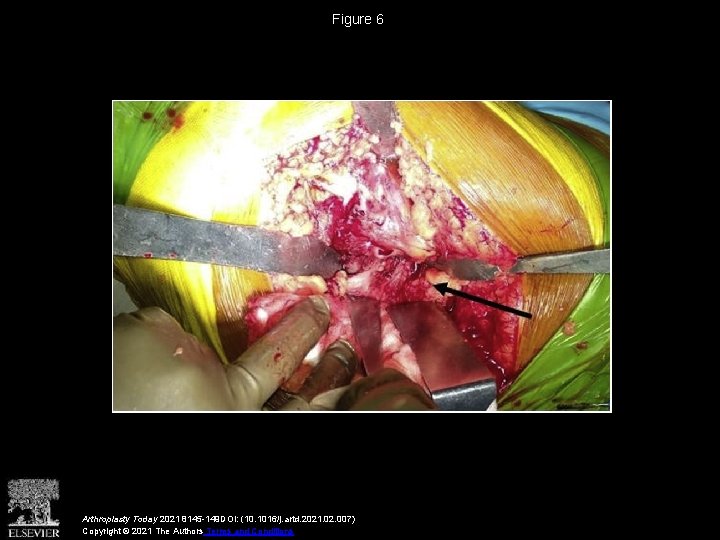 Figure 6 Arthroplasty Today 2021 8145 -149 DOI: (10. 1016/j. artd. 2021. 02. 007)