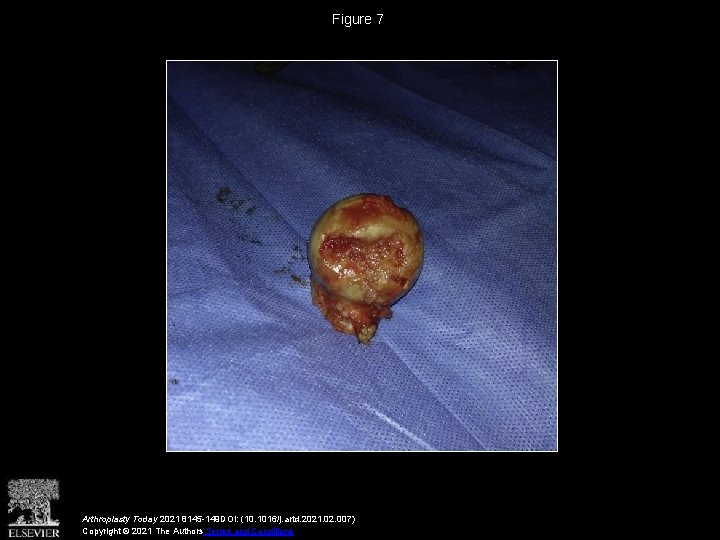 Figure 7 Arthroplasty Today 2021 8145 -149 DOI: (10. 1016/j. artd. 2021. 02. 007)