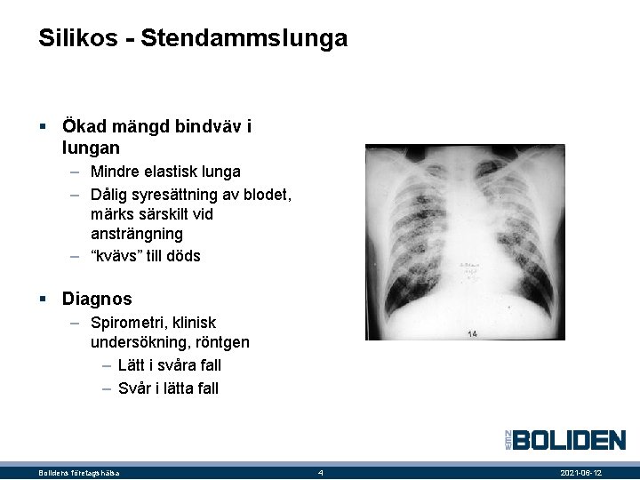 Silikos - Stendammslunga § Ökad mängd bindväv i lungan ‒ Mindre elastisk lunga ‒
