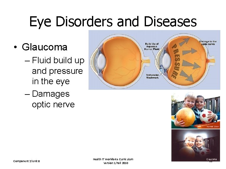 Eye Disorders and Diseases • Glaucoma – Fluid build up and pressure in the