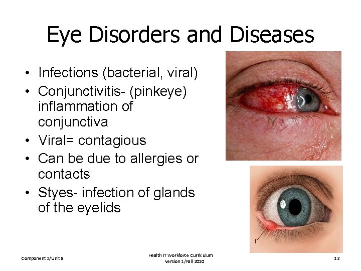 Eye Disorders and Diseases • Infections (bacterial, viral) • Conjunctivitis- (pinkeye) inflammation of conjunctiva