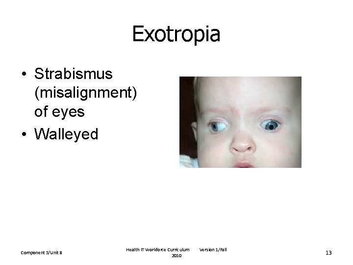 Exotropia • Strabismus (misalignment) of eyes • Walleyed Component 3/Unit 8 Health IT Workforce