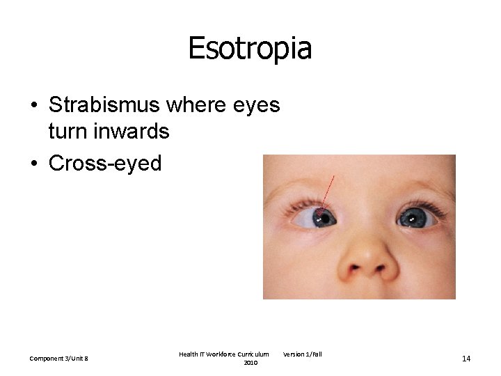 Esotropia • Strabismus where eyes turn inwards • Cross-eyed Component 3/Unit 8 Health IT