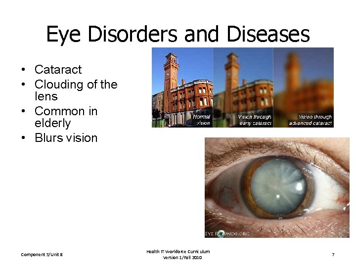 Eye Disorders and Diseases • Cataract • Clouding of the lens • Common in