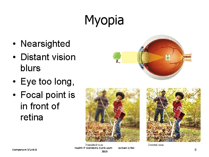 Myopia • Nearsighted • Distant vision blurs • Eye too long, • Focal point