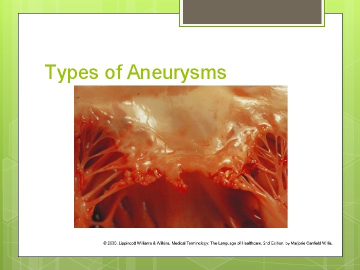 Types of Aneurysms 