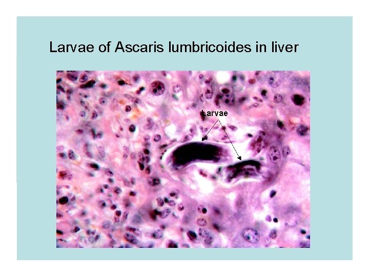 Larvae of Ascaris lumbricoides in liver Larvae Larvae of Ascaris lumbricoides in liver Larvae