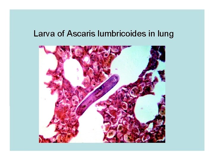 Larva of Ascaris lumbricoides in lung Larva of Ascaris lumbricoides in lung