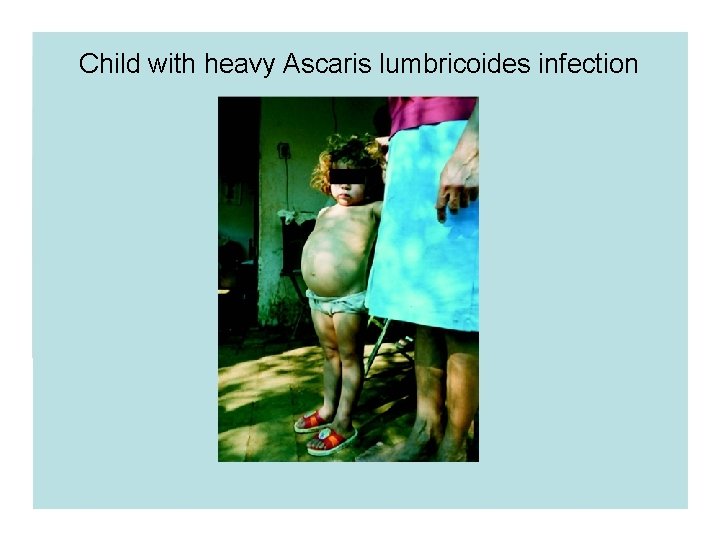 Child with heavy Ascaris lumbricoides infection Child with heavy Ascaris lumbricoides infection
