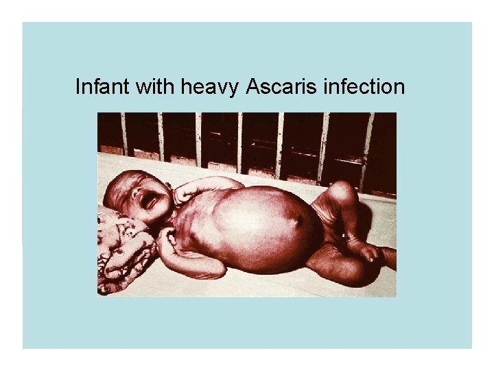 Infant with heavy Ascaris infection Infant with heavy Ascaris infection