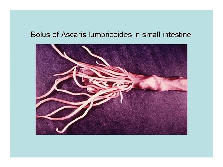 Bolus of Ascaris lumbricoides in small intestine Bolus of Ascaris lumbricoides in small intestine